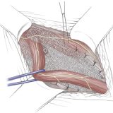 mySurgery | Hernia